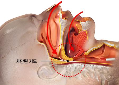 수면 무호흡 시 차단된 기도 상태